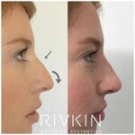 Pin on Dr. Rivkin's Non Surgical Nose Job