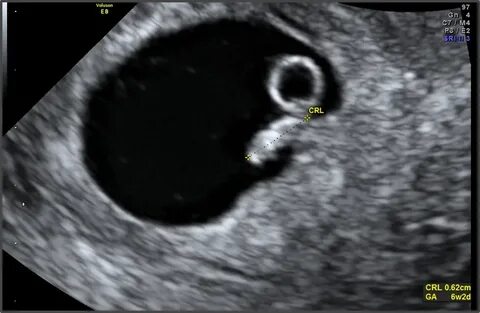 8 Weeks 6 Days Ultrasound Pictures / I've had so many ultras