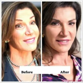Hilary Farr Plastic Surgery Photos Before & After - Surgery4