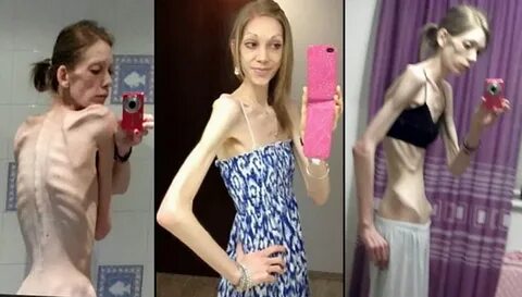This Former Anorexic Girl Just Won A Bodybuilding Competitio