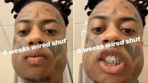Boonk Gang Says His Jaw Will Be Wired Shut For 6 Weeks After
