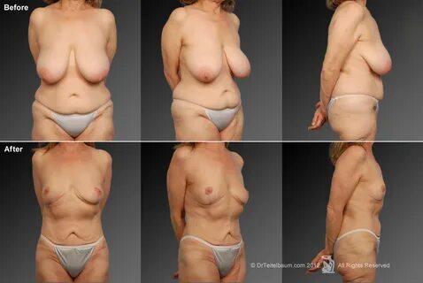 Teitelbaum Weight Loss Bariatric Before & After Gallery