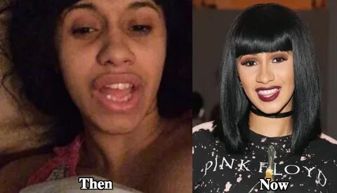 Cardi B Teeth Before and after - Latest Plastic Surgery Goss