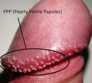 Penile papules on shaft treatment Pearly Penile Papules