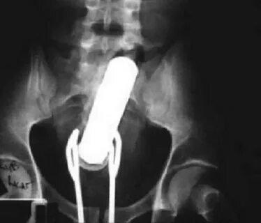 Funny X-ray Images: 30 Of The Most Unbelievably Weird X-rays