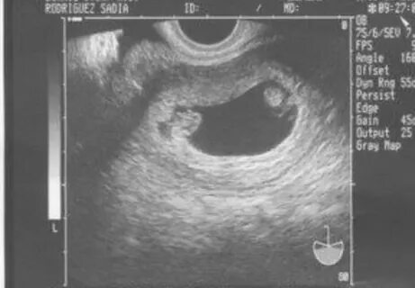 Possible twins? - February 2018 - BabyCenter Australia