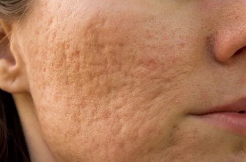 Face scars from picking or acne. What to do if you're not se