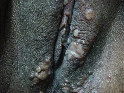 Vesicles and erosions in herpes genitalis Download Scientifi