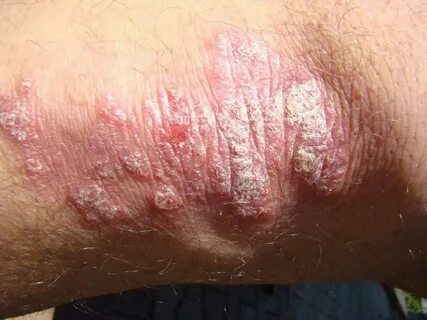 Special immune cells triggers psoriasis / Health News Altern