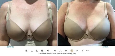 how much does a vampire breast lift cost - www.adaytoadore.co.uk.