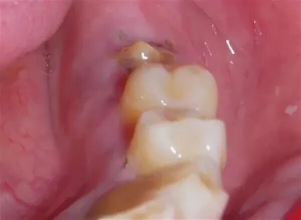 Popanz 2: Wurzelreste machen automatisch krank - Zahnfilm DE