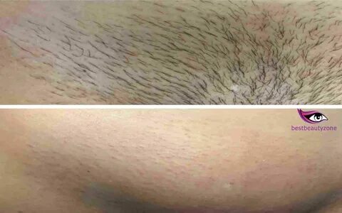 Brazilian Wax Before And After Pictures - Ikable Online