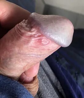 Very red swollen spots on foreskin and swollen veins after s
