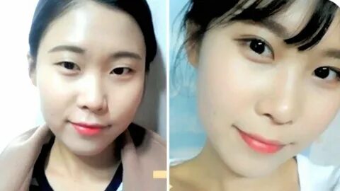 Double Eyelid Surgery: A Basic Guide " Grace Chua