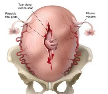 Uterus rüptürü - Tıpacı