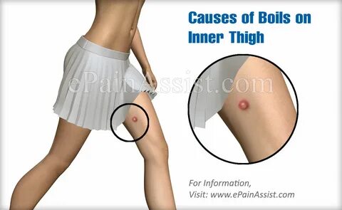 Boils on Inner Thigh Causes Risk Factors Symptoms Treatment 