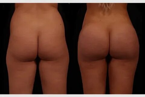 Brazilian Butt Augmentation (Butt Lift) Case #5043 Andrew Tr