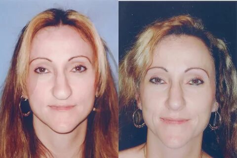 Nose Surgery Before & After Photos Patient 60 San Francisco,