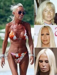 #LipFillersAftercare Celebrity plastic surgery, Donatella ve