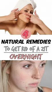 4 natural remedies to get rid of a zit overnight Beauty