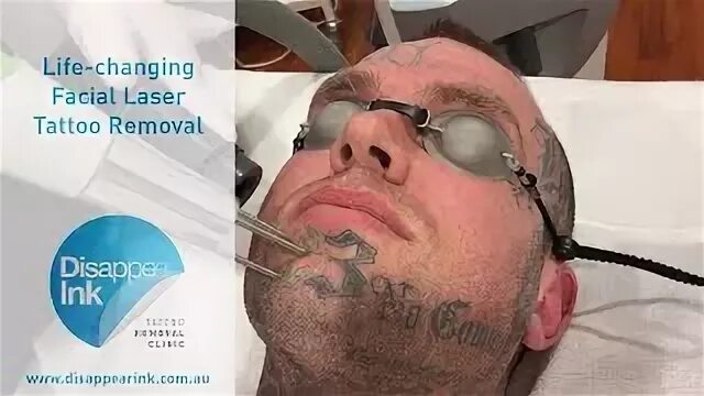 Tattoo Removal Face - Ladda ner