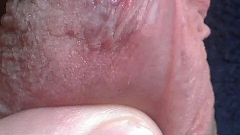 What Happens If You Pop Pearly Penile Papules? - YouTube