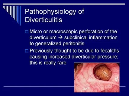 Sigmoid Colon Infection 10 Images - Diverticular Disease Of 
