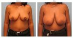 How To Get More Results Out Of Your Best Breast Reduction Su