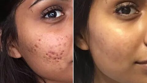 Here's Why This Woman's Cystic Acne Routine Is SO Controvers