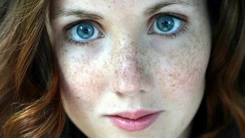 Freckles - Easy Home Remedy & Herbal Medicine