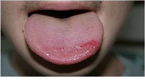 Burning Mouth Syndrome - Symptoms, Types And Causes