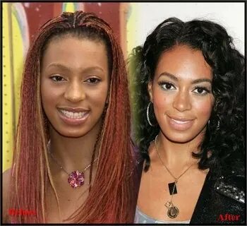 Ciara Nose Job Pictures Before and After effects Nose job, P