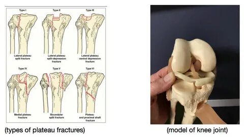 Sports Docs Weekly Blitz: Tibial plateau fracture ends JJ Wa
