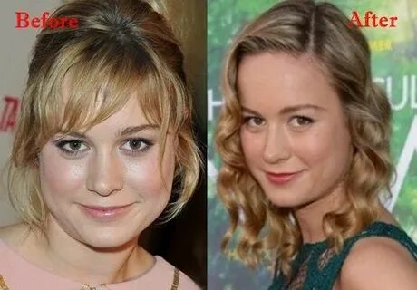 Brie Larson Plastic Surgery Before and After