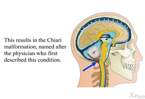 PatEdu.com : Posterior Decompression of Chiari Malformation