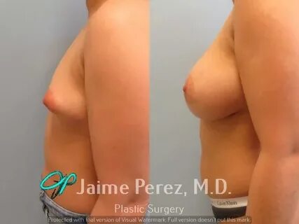 24-Year-Old Female: Breast Augmentation with 475cc Silicone 