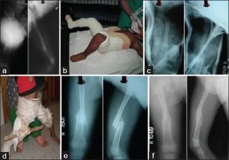 Children with femoral shaft fractures: Before hip spica X-ra