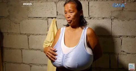 A Case Of Largest Breasts In A 54-Years-Old Woman - Newspape