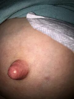 Why do i have white pimples on my nipples Bumps on & around Nipple. 2020-03-21