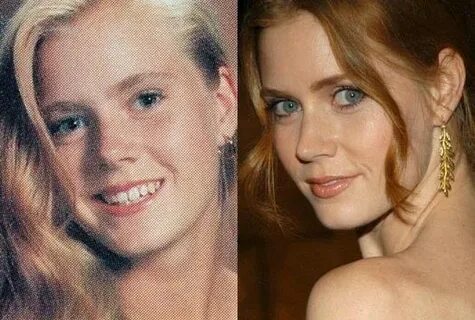 Amy Adams before and after plastic surgery Celebrity plastic