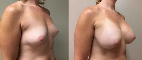 Breast Augmentation Photos 25 Plastic Surgeon Scottsdale