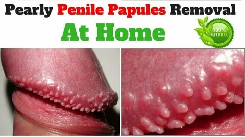 Pearly penile papules removal - link below description - You