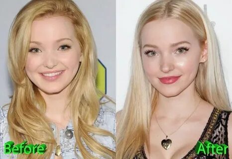 Dove Cameron Before and After Cosmetic Surgery Plastic surge