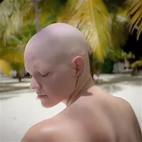 140 Bald ideas balding, bald women, bald girl