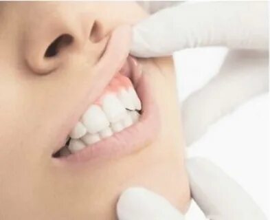 Periodontist in Fort Mill, SC Gum Disease & Tooth Loss