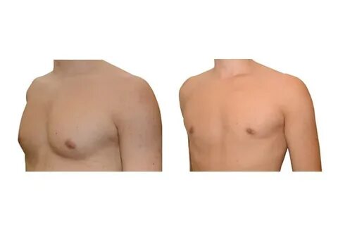 Gynekomastia (enlarged breasts in men) - Vienna - Dr. Turkof