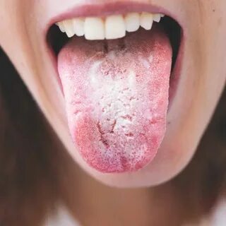 Stop the Sugar Cravings and the Fuzzy Thinking! Yeast infect