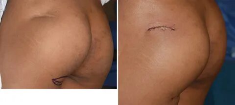 Plastic Surgery Case Study - Dermal-Fat Grafting Of Buttock 