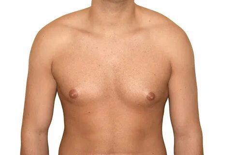 Männerbrust - Brustverkleinerung für den Mann und Brustchiru