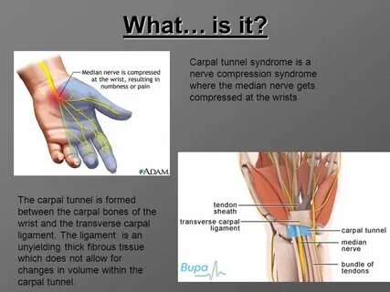 Carpal Tunnel Syndrome - ppt video online download